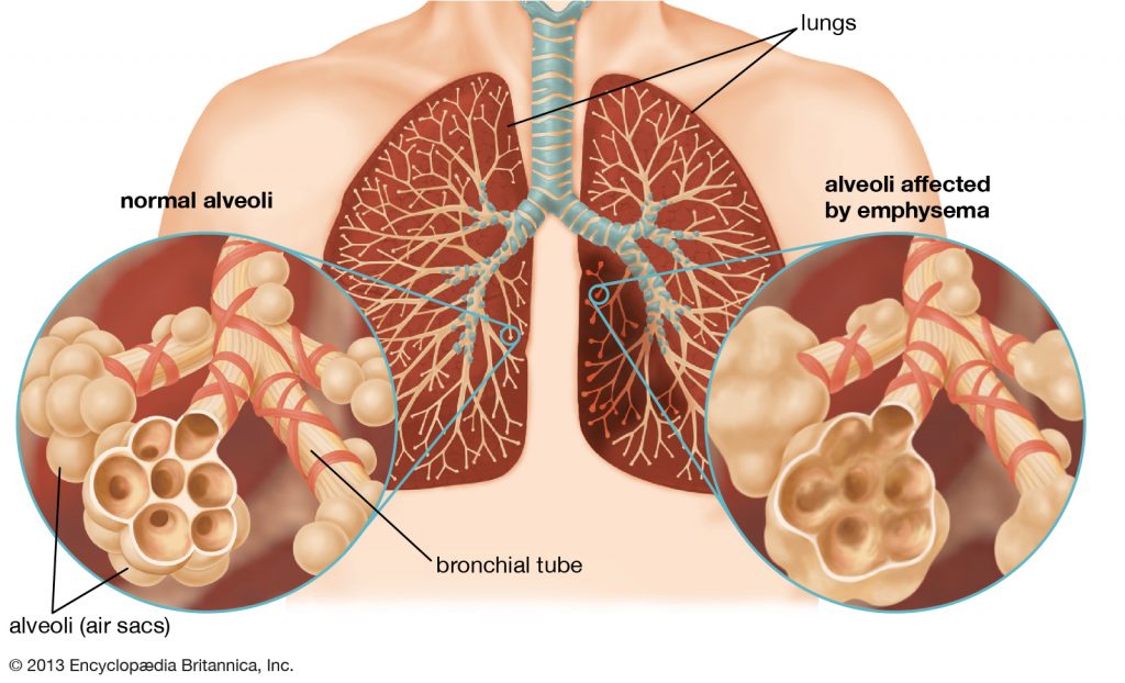CHRONIC OBSTRUCTIVE PULMONARY DISEASE